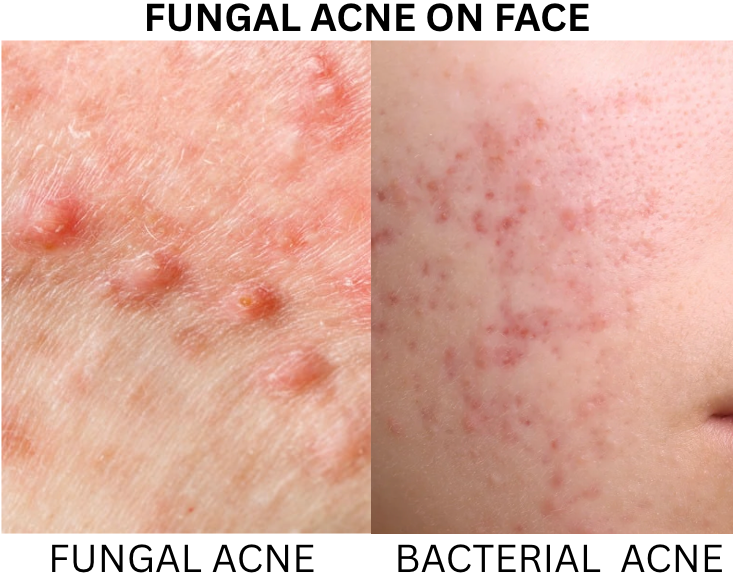 Fungal Acne Pictures