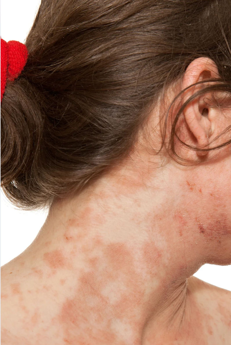 Perioral dermatitis causes