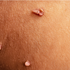Genital Warts vs Herpes: Understanding Symptoms and Treatment Options