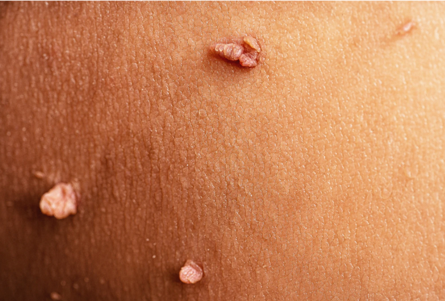 Image of Genital wart