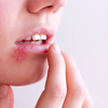 Herpes vs Pimple: Key Differences You Need to Know