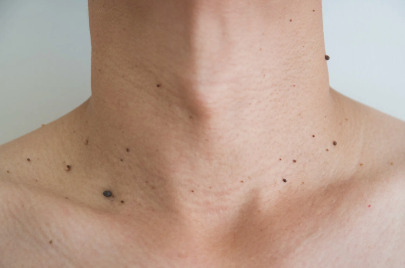 Skin tag on a persons neck