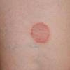 Rashes That Look Like Ringworm But Aren't