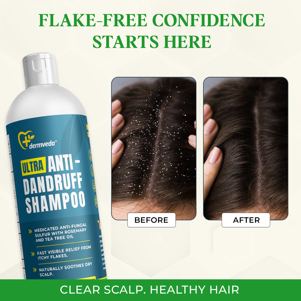 Ultra Anti-Dandruff Shampoo, Medicated Fungus-control Sulphur Formula With Rosemary, and Tea Tree Oil, Relief from Itchy Flakes and Dry Scalp