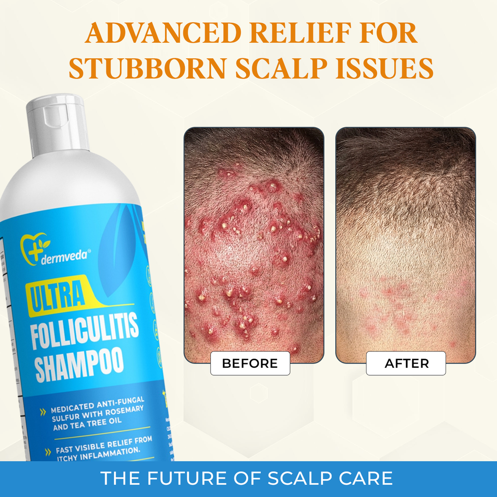 Dermveda Folliculitis Shampoo for Itchy Dry Scalp Flaking and Scaling, Fragrance-Free Homeopathic Formula, 4 Fl Oz