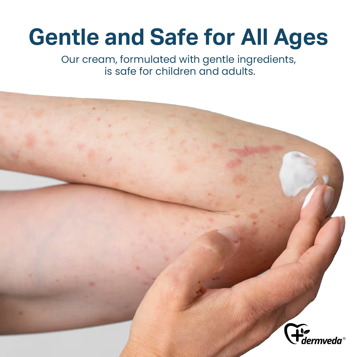 Image depicting skin with raised red welts caused by hives due to insect bites, highlighting allergic reaction symptoms