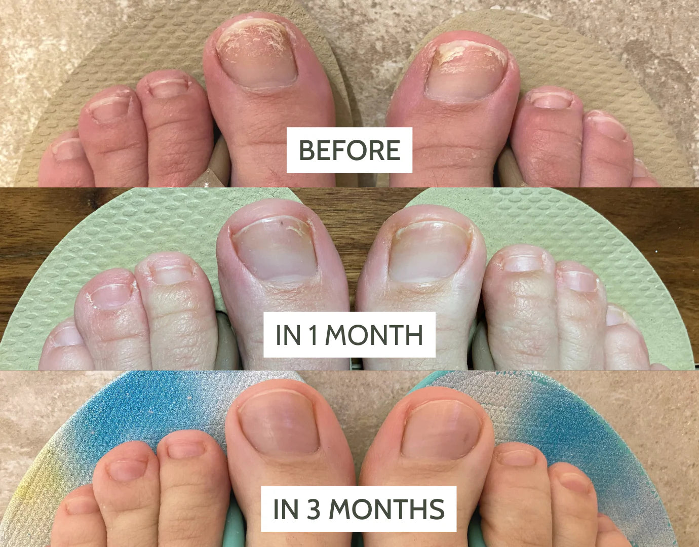 Dermveda Toenail Fungus Treatment Extra Strength - Antifungal Nail Renewal | Nail Care