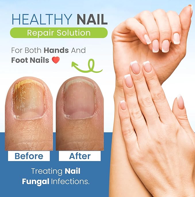 Dermveda Toenail Fungus Treatment Extra Strength - Antifungal Nail Renewal | Nail Care